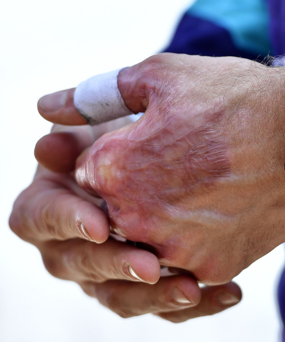 Grosjean underwent multiple surgeries on his left hand to ease the pain caused by his time spent inside the fire.